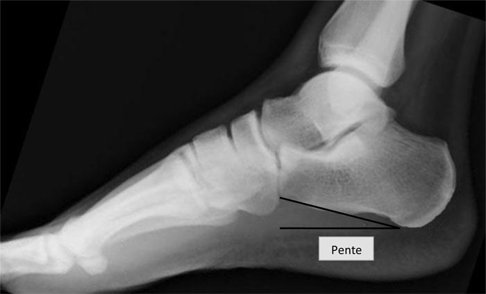 Radiographie Des Os Du Pied Membre Inf rieur Radiographie Radiographie Des Os Du Pied Membre Inf rieur Radiographie